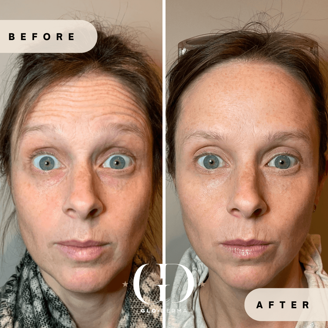 Before and After Image of Botox Dysport Treatment By GloDerma Aesthetics in Yardley, PA