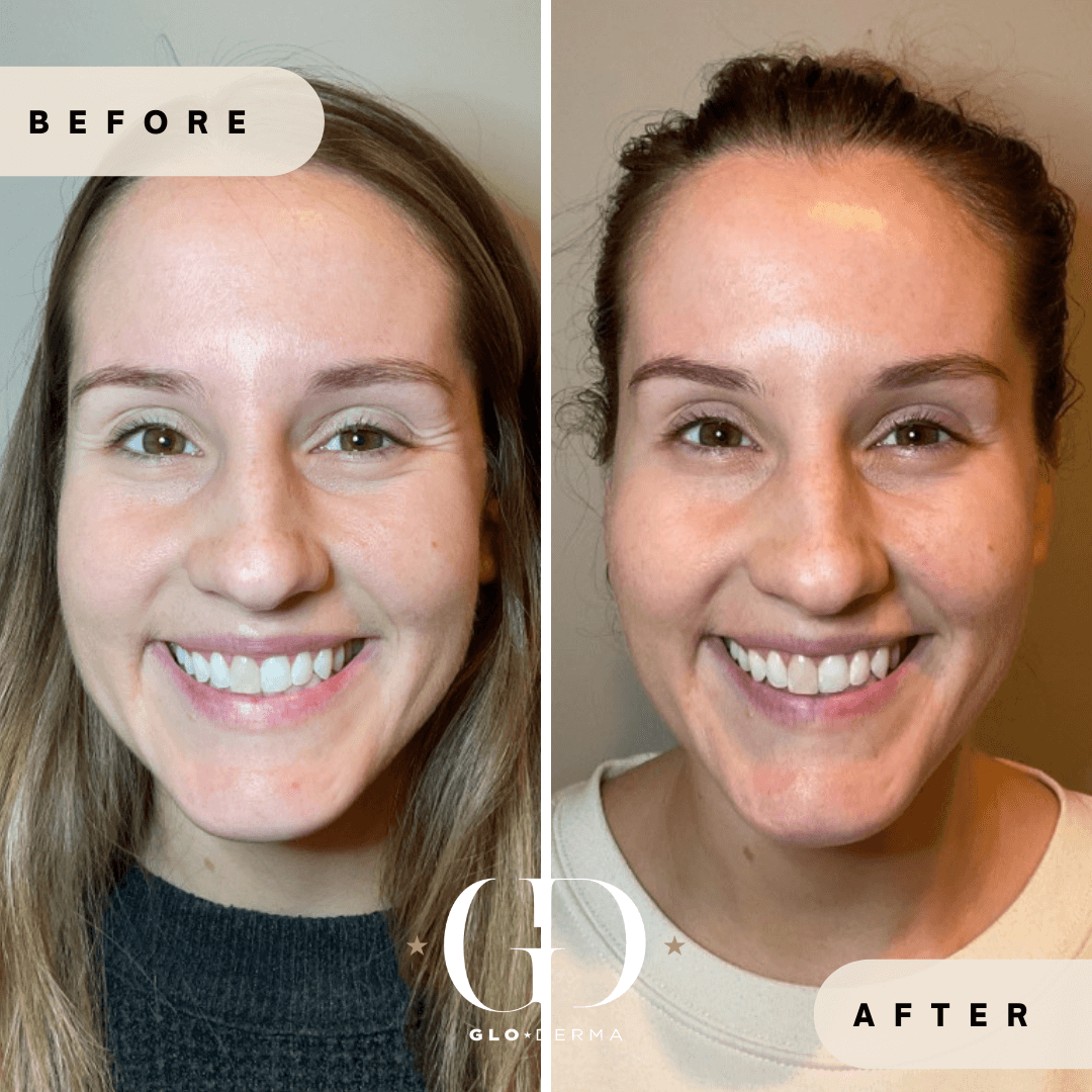 Before and After Image of Botox Dysport Treatment By GloDerma Aesthetics in Yardley, PA