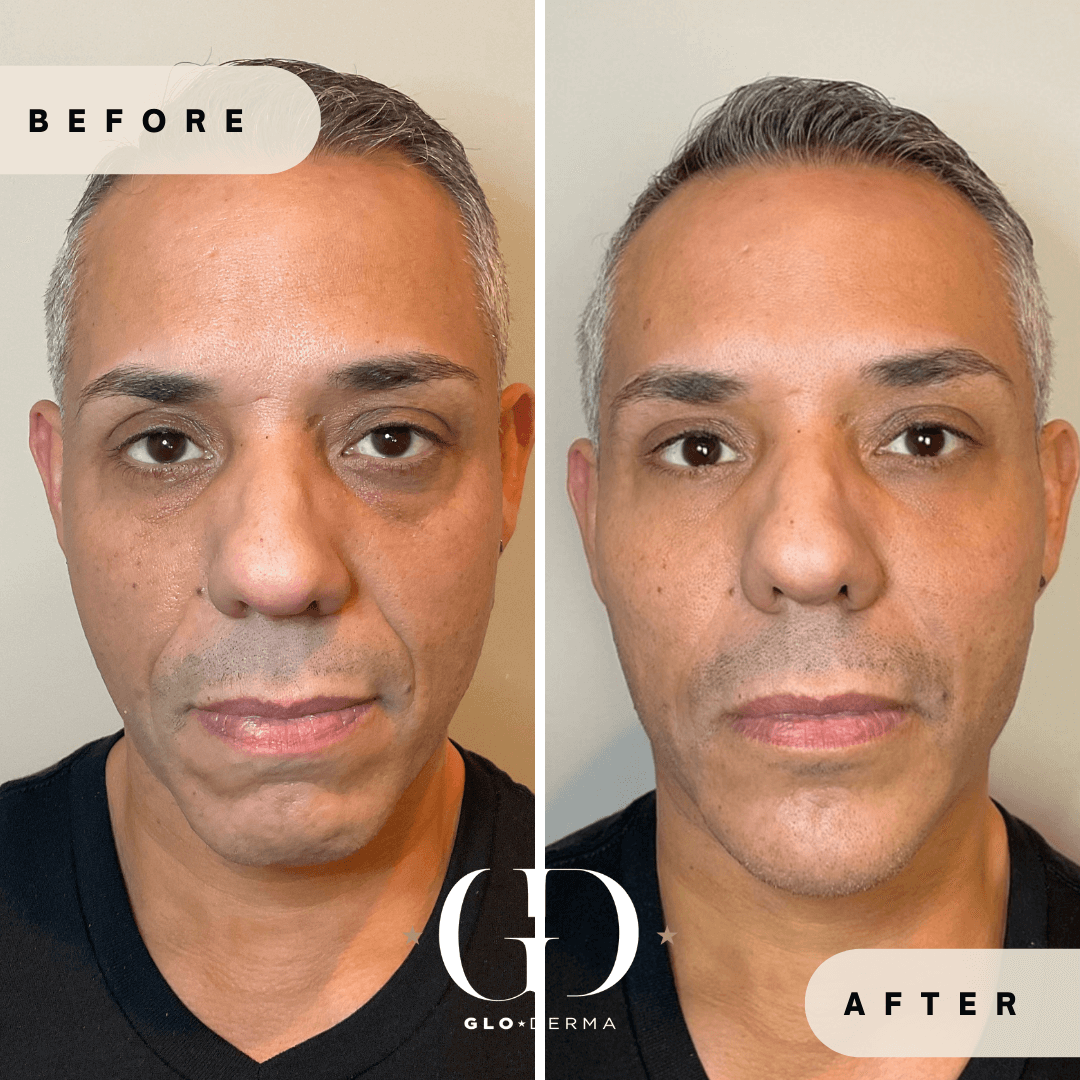 Before and After Image of Facial Harmonization Treatment By GloDerma Aesthetics in Yardley, PA