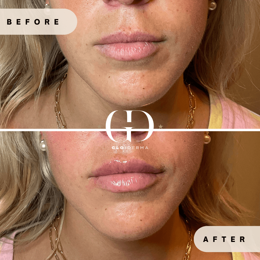 Before and After Image of Lips Treatment By GloDerma Aesthetics in Yardley, PA