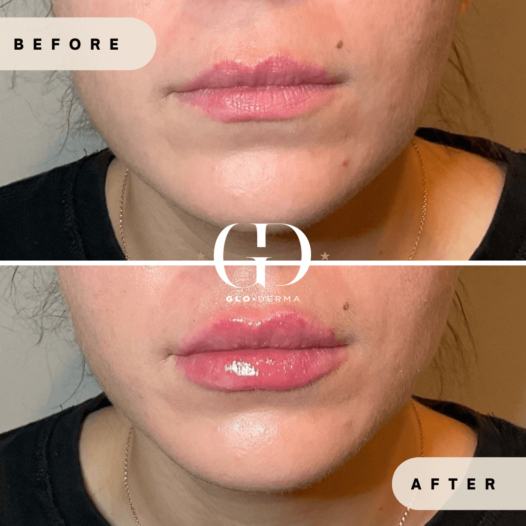 Before and After Image of Lips Treatment By GloDerma Aesthetics in Yardley, PA