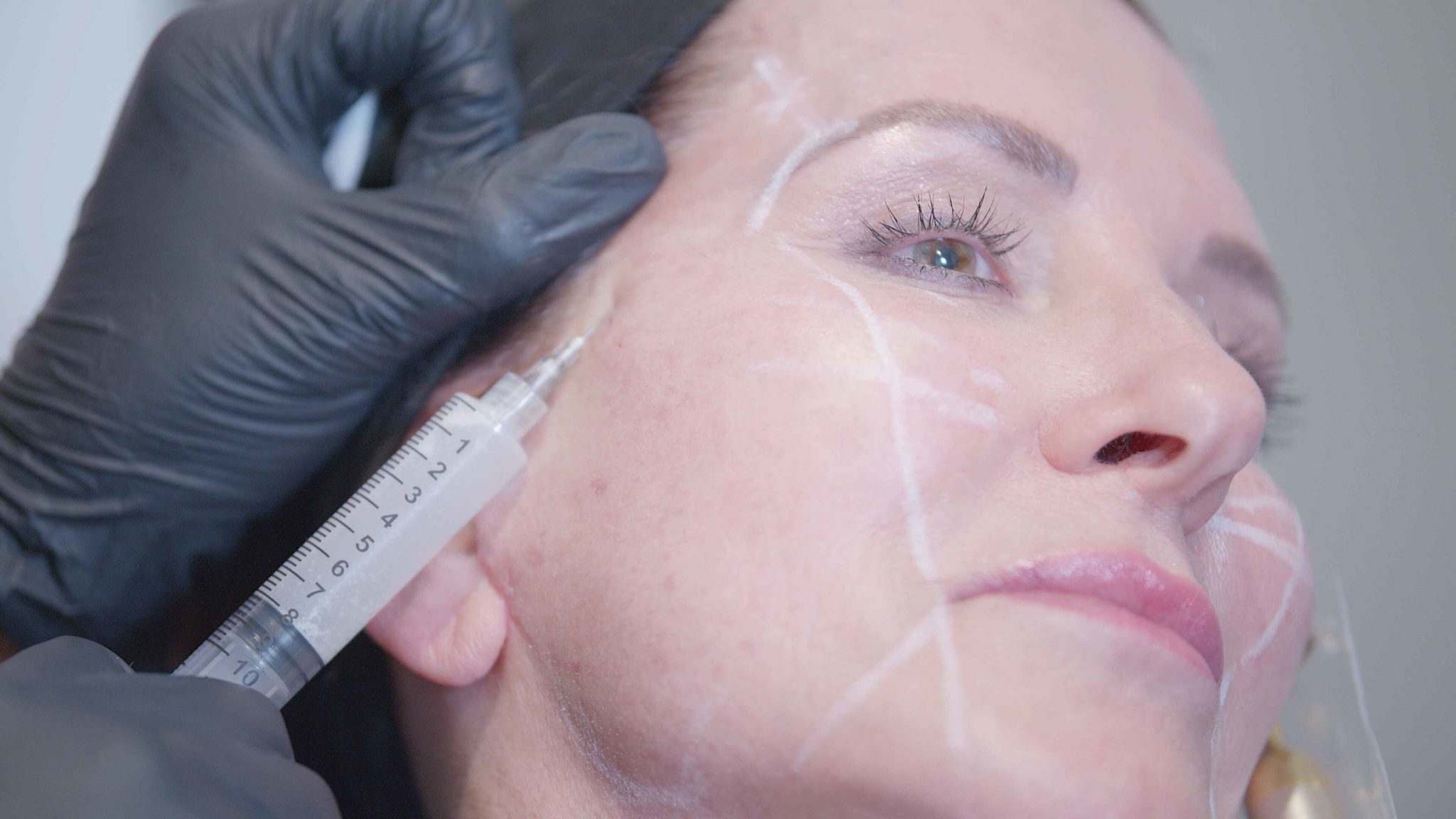 Sculptra By GloDerma Aesthetics in Yardley, PA