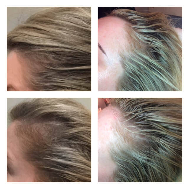 Before and After Image of PRP PRF Treatments By GloDerma Aesthetics in Yardley, PA
