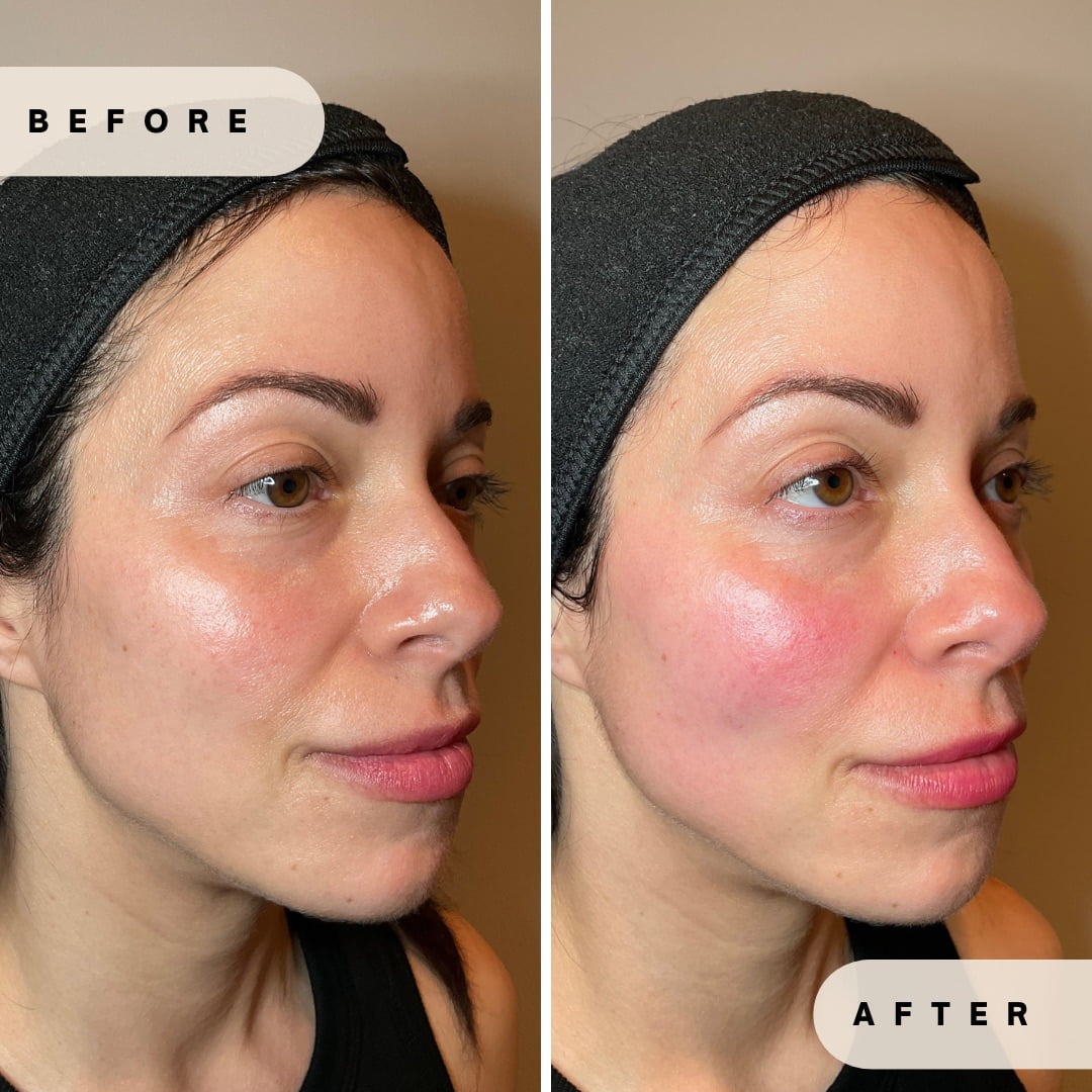 Face Rejuvenation Before and after Images in Yardley PA at Glo Derma