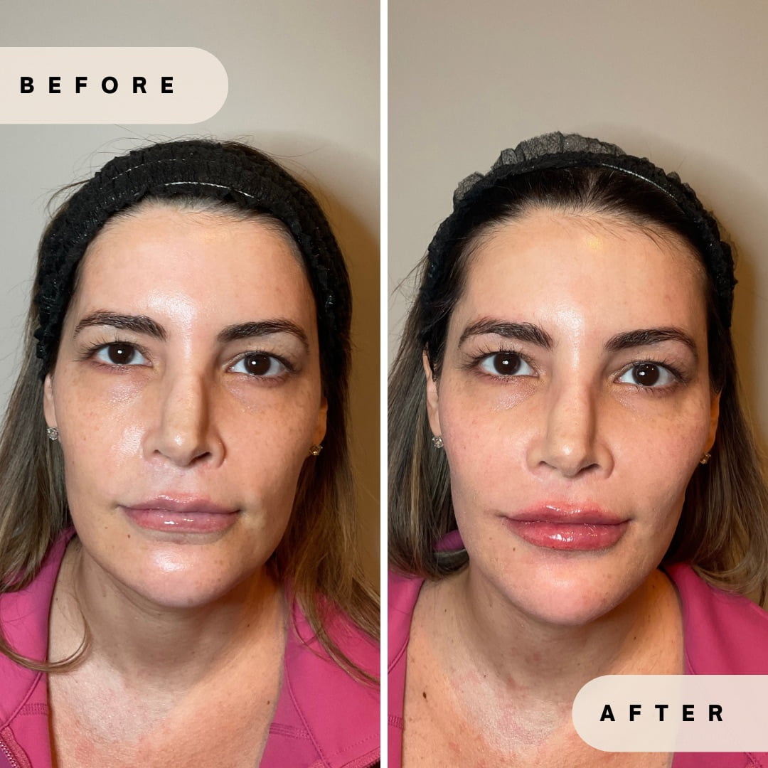 Face Rejuvenation Before and after Images in Yardley PA at Glo Derma