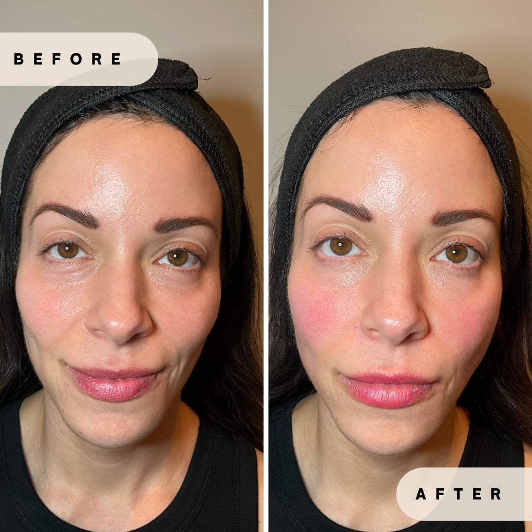 Face Rejuvenation Before and after Images in Yardley PA at Glo Derma