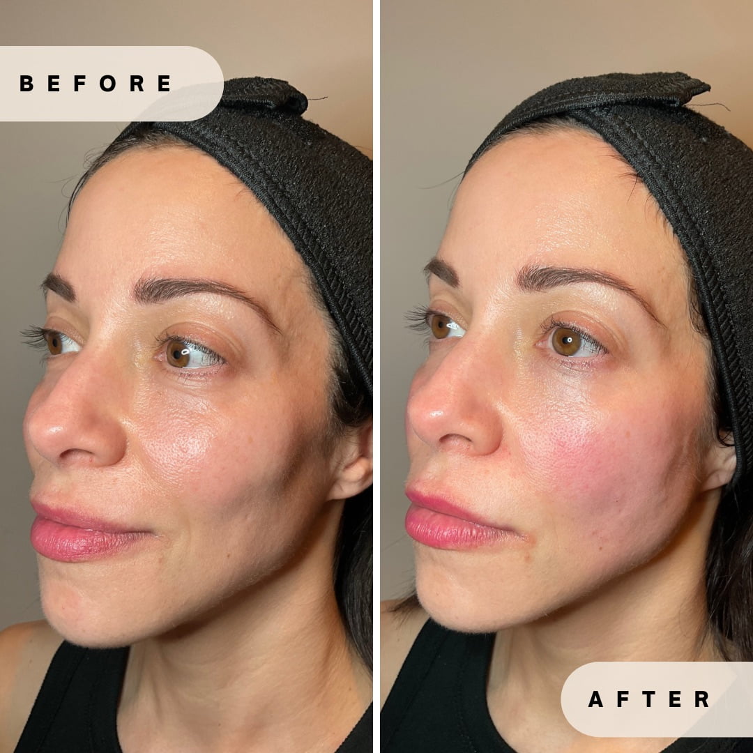 Face Rejuvenation Before and after Images in Yardley PA at Glo Derma