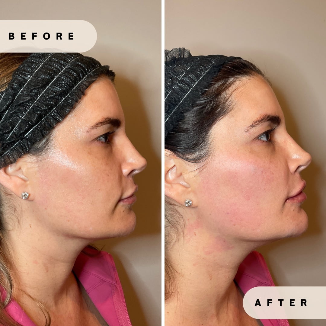 Face Rejuvenation Before and after Images in Yardley PA at Glo Derma