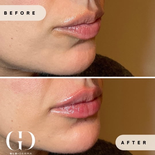 Lip Enhancement Before and after Images in Yardley PA at Glo Derma