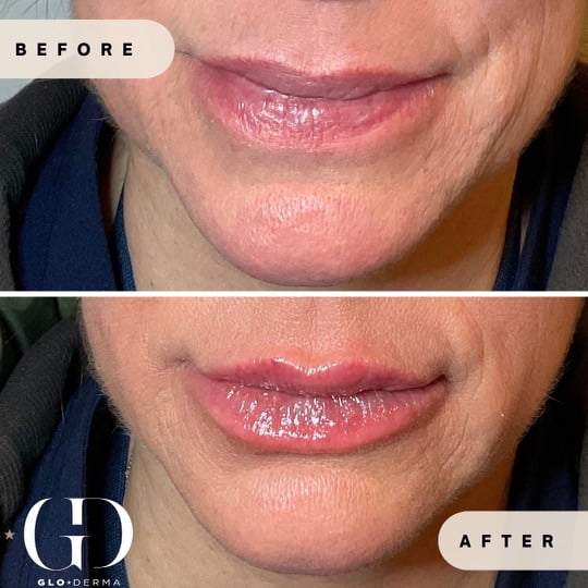Lip Enhancement Before and after Images in Yardley PA at Glo Derma