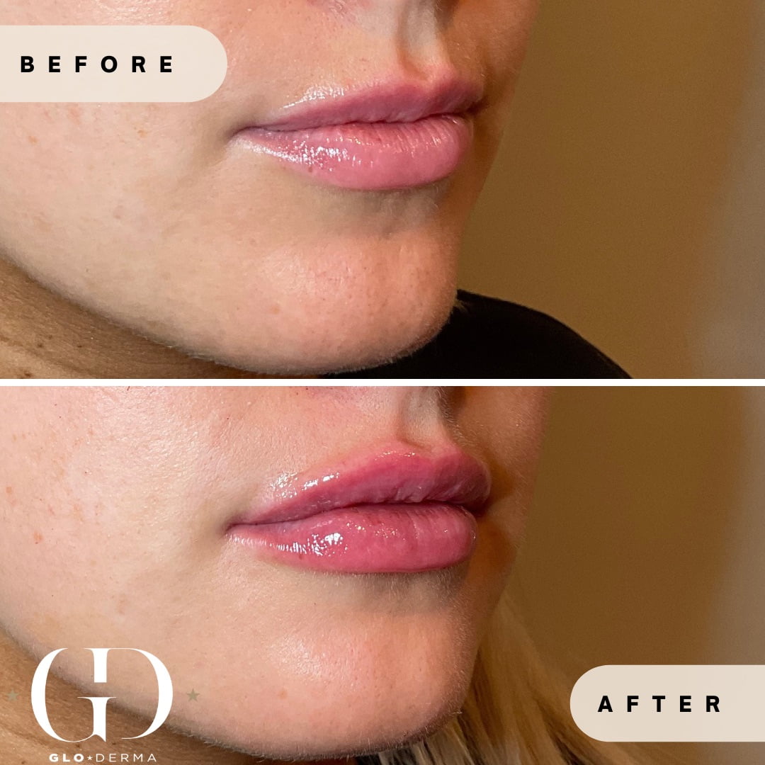 Lip Enhancement Before and after Images in Yardley PA at Glo Derma