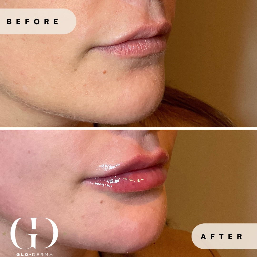 Lip Enhancement Before and after Images in Yardley PA at Glo Derma