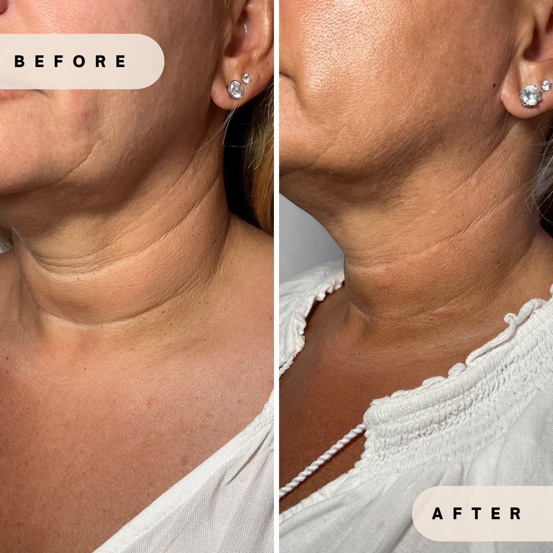 Face transformation after aesthetic injections (natural finish) in Yardley PA at Glo Derma
