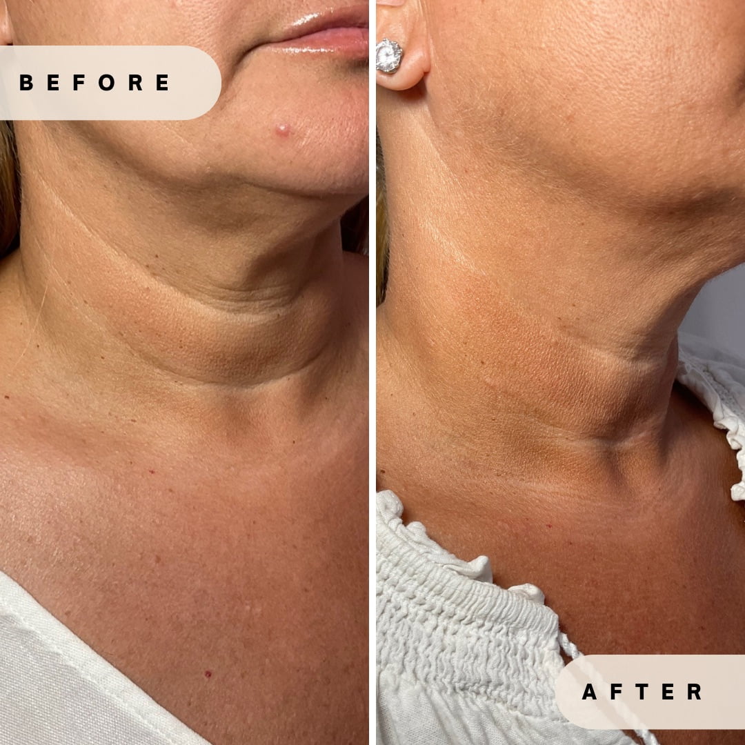 Before-and-after cheek filler on woman’s face in Yardley PA at Glo Derma
