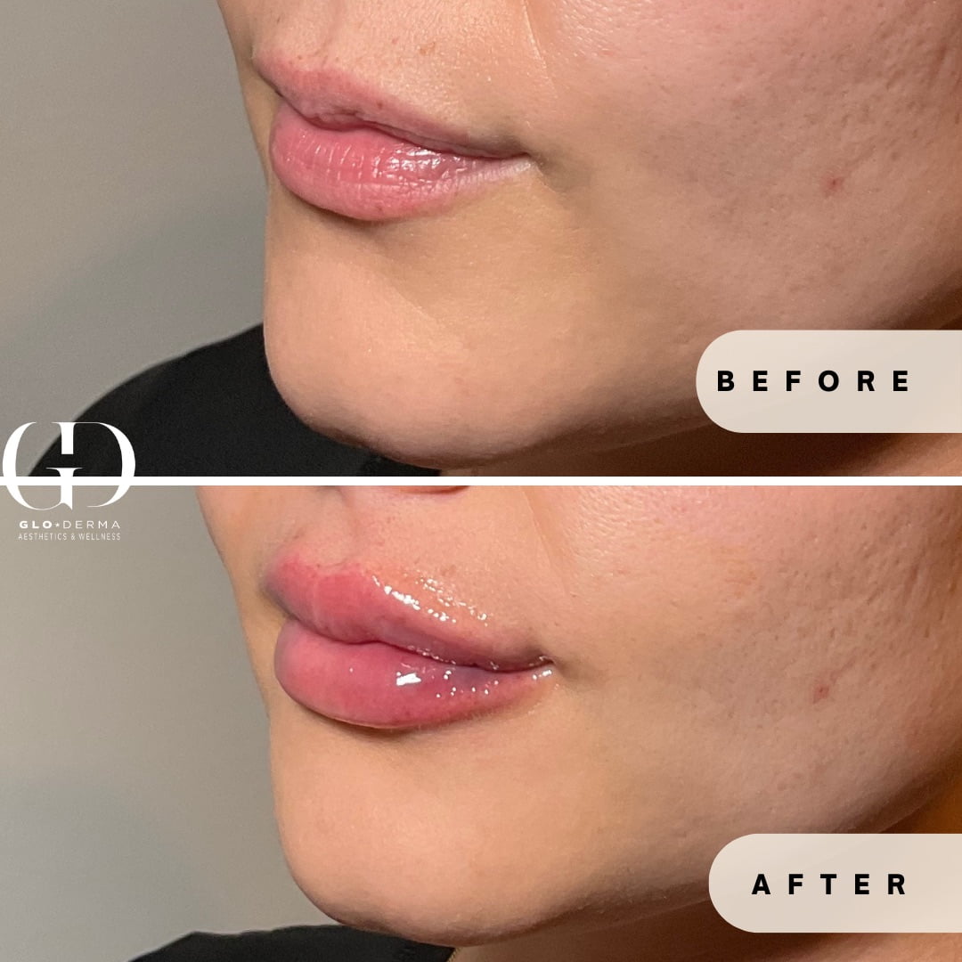 Close-up of lips post-augmentation treatment in Yardley PA at Glo Derma