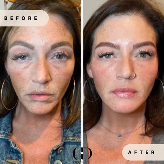 Middle-aged female with rejuvenated skin tone and texture