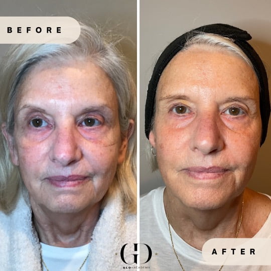 Side-by-side before-and-after facial rejuvenation of older woman