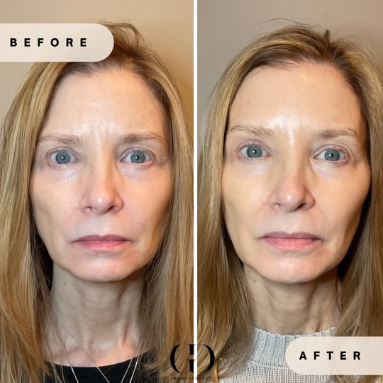 Side-by-side before-and-after showing smoother skin and reduced lines