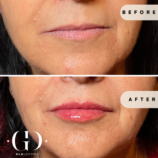 Facial filler before-and-after showing improved jawline and wrinkles by Glo Derma
