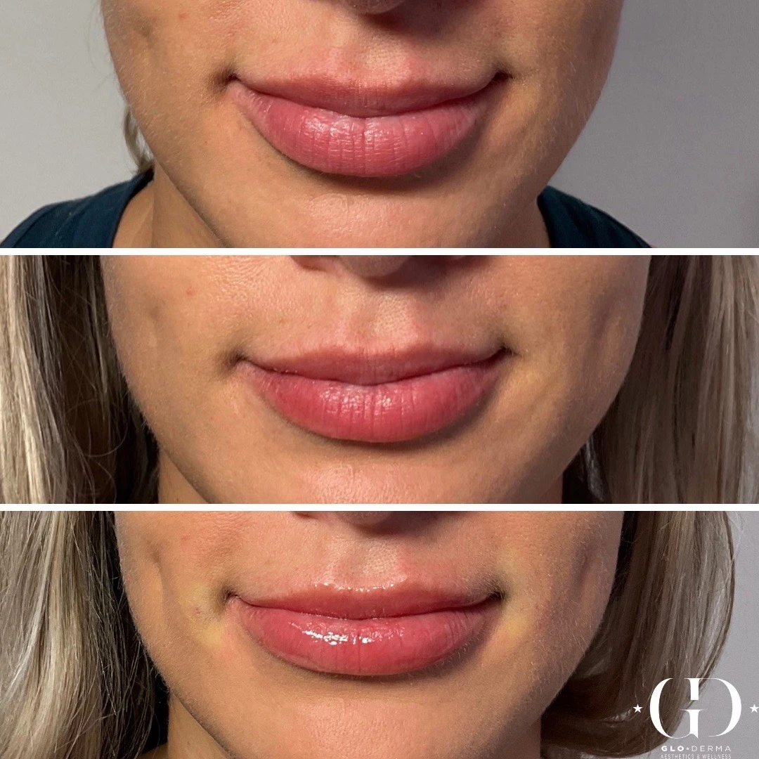Lip filler treatment before-and-after images from Glo Derma