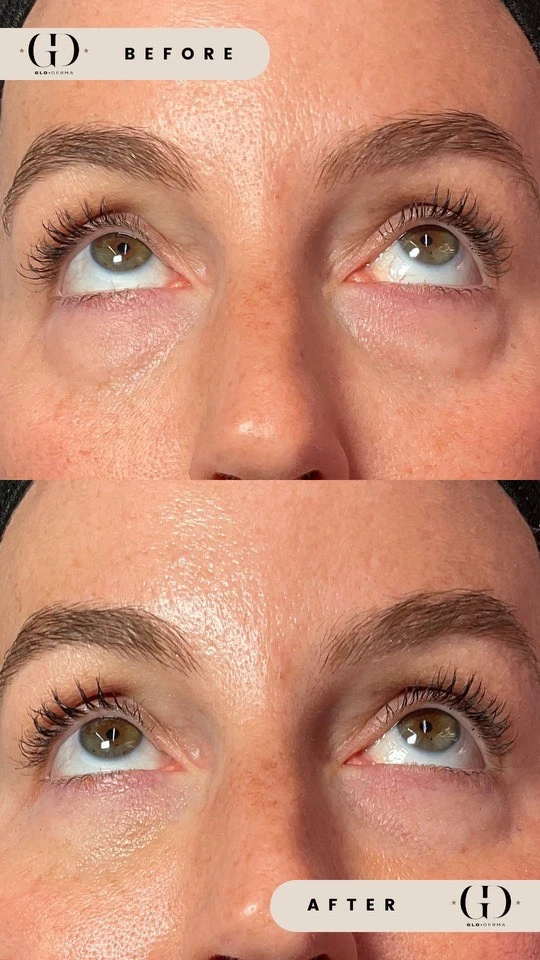 Close-up of eyes and forehead showing smoother skin texture at Glo Derma in Yardley, PA