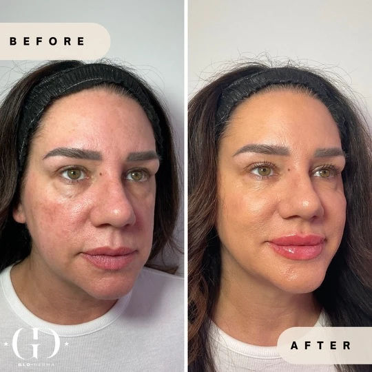 Facial transformation series: before-and-after of two clients at Glo Derma in Yardley, PA