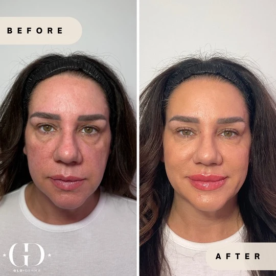 Facial transformation series: before-and-after of two clients at Glo Derma in Yardley, PA