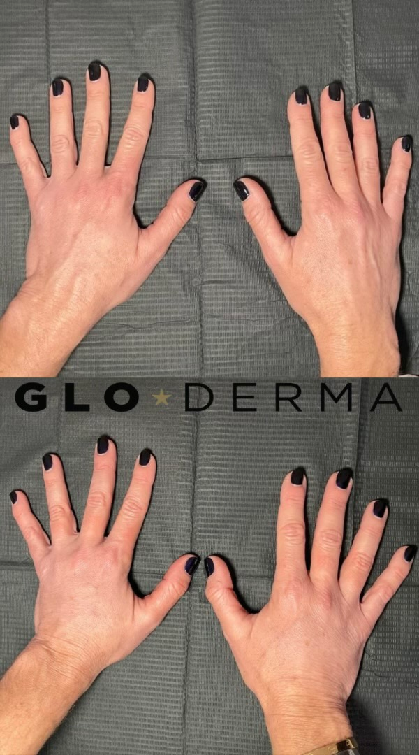 Hands showing before and after transformation with Glo Derma Medspa treatments in Yardley, PA
