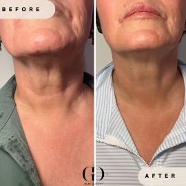 Renuva Treatment in Yardley, PA at Glo Derma
