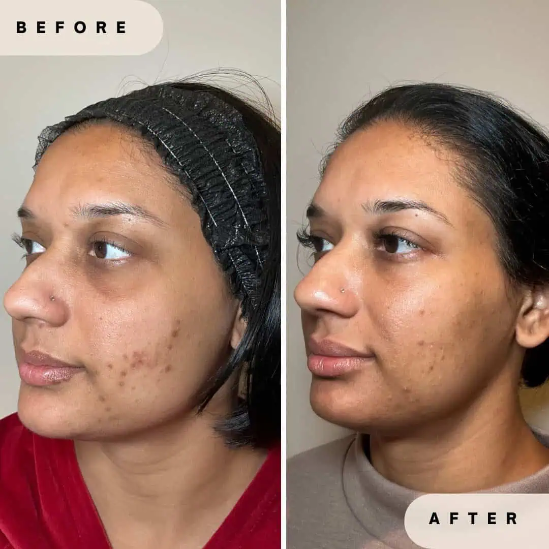 Platelet-Derived Growth Factor (PDGF) Before and After Results at Glo Derma Yardley, PA